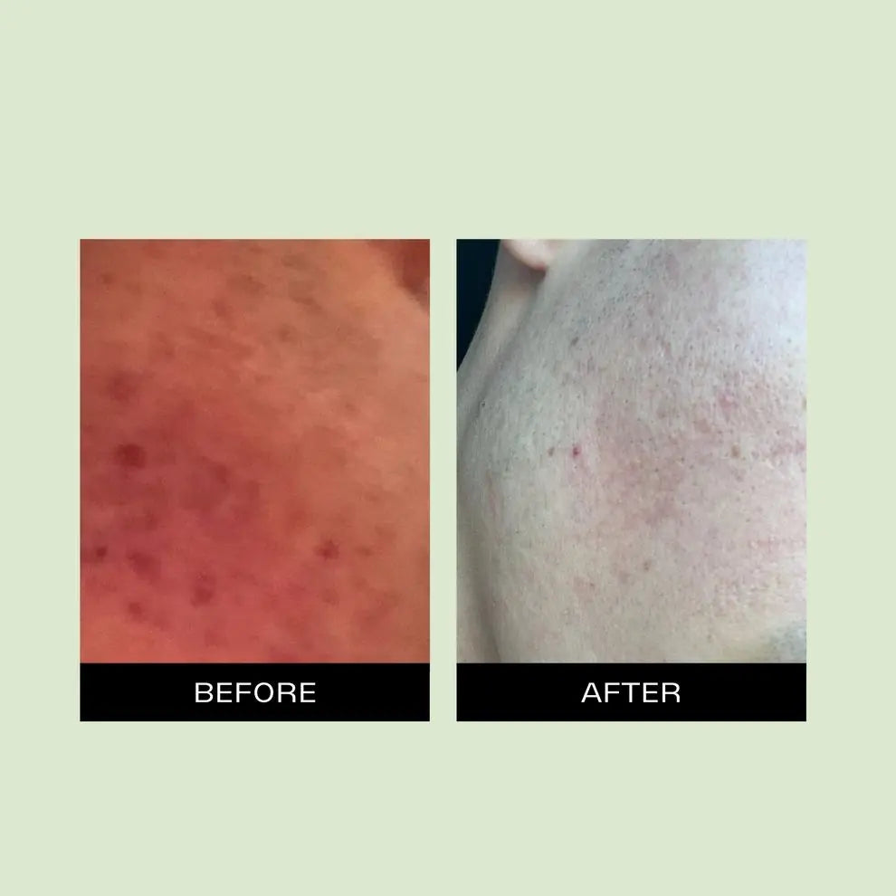 Meraki Healthy Hyaluronic Acid + Turmeric Moisturizer in elegant packaging. Natural hydrating face cream that boosts glow, reduces dark spots, and improves skin texture. Vegan, cruelty-free, and handmade for all skin types. Formulated with hyaluronic acid for deep hydration and turmeric for brightening. Perfect daily moisturizer for a healthy, radiant complexion.
